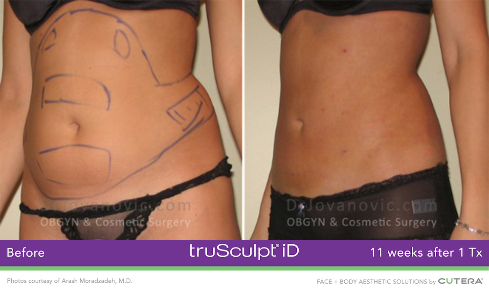 truSculpt ID Before and After