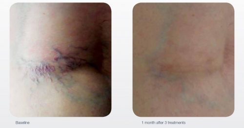 Spider Veins