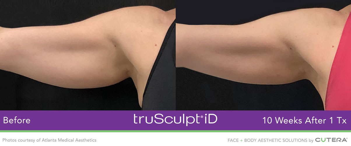 truSculpt ID Before and After