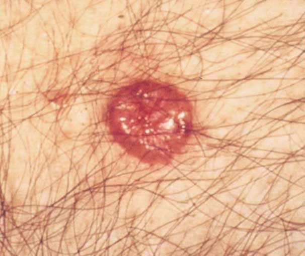 Basal Cell Carcinoma 2