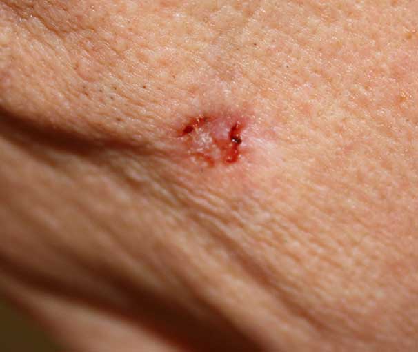Basal Cell Carcinoma