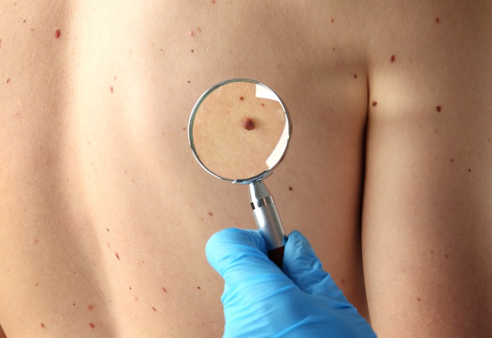 Moles