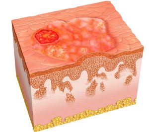 Squamous Cell Carcinomas